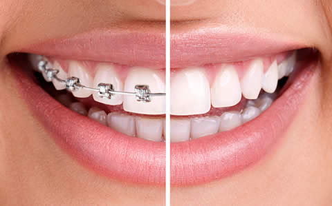 Reasons for teeth straightening